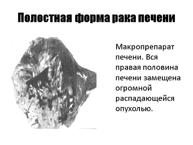 Полостная форма рака печени  Макропрепарат печени. Вся правая половина печени замещена огромной распадающейся